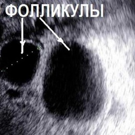 Что такое фолликулометрия и когда ее делают