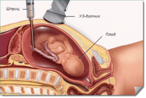 Фото: Точность биопсии хориона