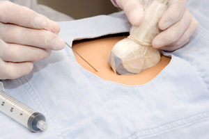 Фото: Подготовка к биопсии хориона - как проходит